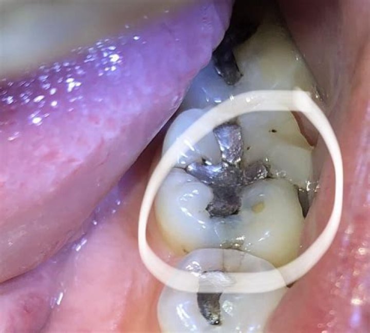 Kremvh’s Tooth Kremvh’s Tooth